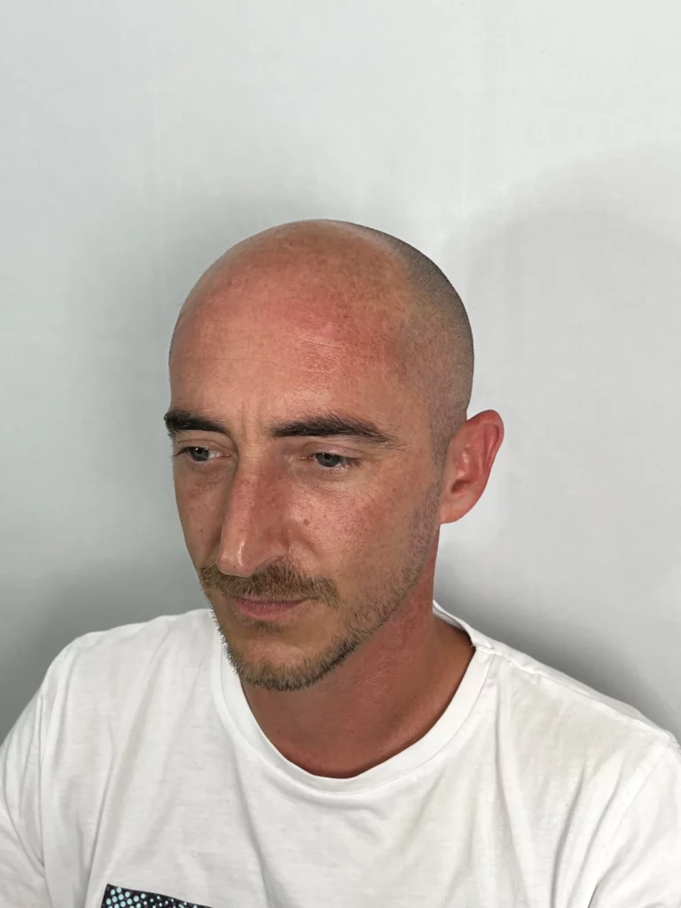 Photo avant une procédure de micro pigmentation capillaire effet rasé chez thomas micropigmentation (sud de la france)