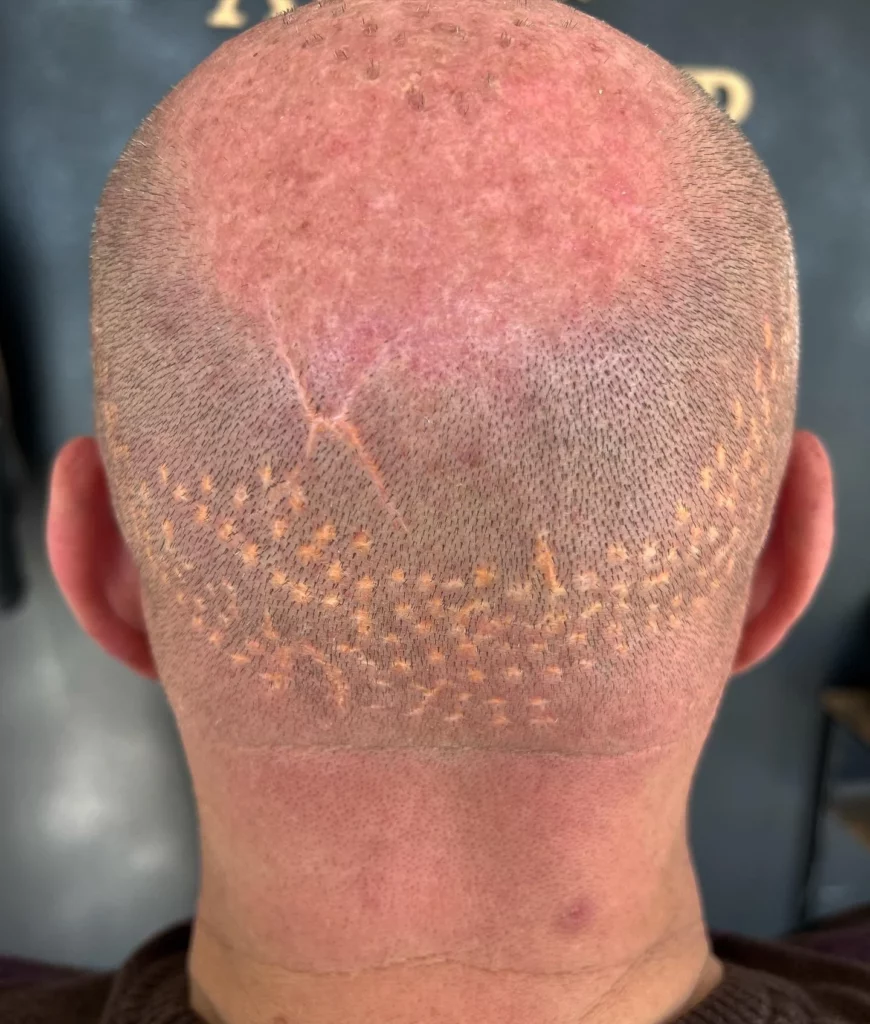 Trichopigmentation du cuir chevelu image avant après montrant le changement après une micro pigmentation capillaire