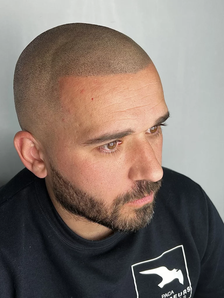 Photo après procédure de micro pigmentation capillair effet rasé chez thomas micropigmentation (sud de la france)