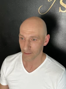 Photo avant une procédure de micro pigmentation capillaire effet rasé chez thomas micropigmentation (sud de la france)