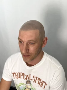 Photo après montrant le résultat d'une procédure de micro pigmentation capillaire effet rasé chez thomas micropigmentation (sud de la france)